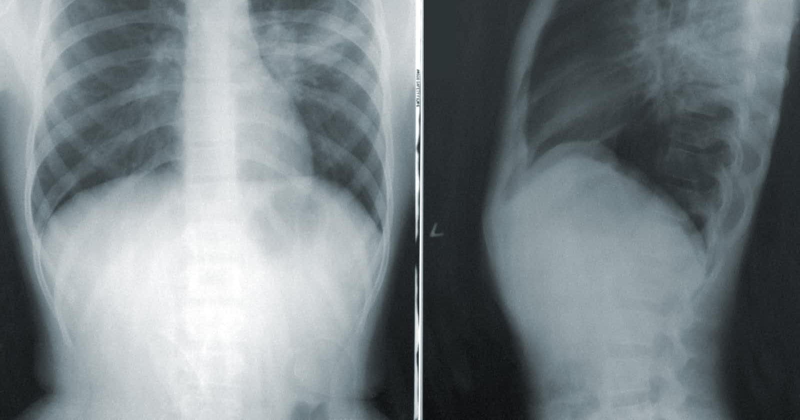 Decoding the Shadows: Pneumonia Classification in Chest X-rays 🫁📸