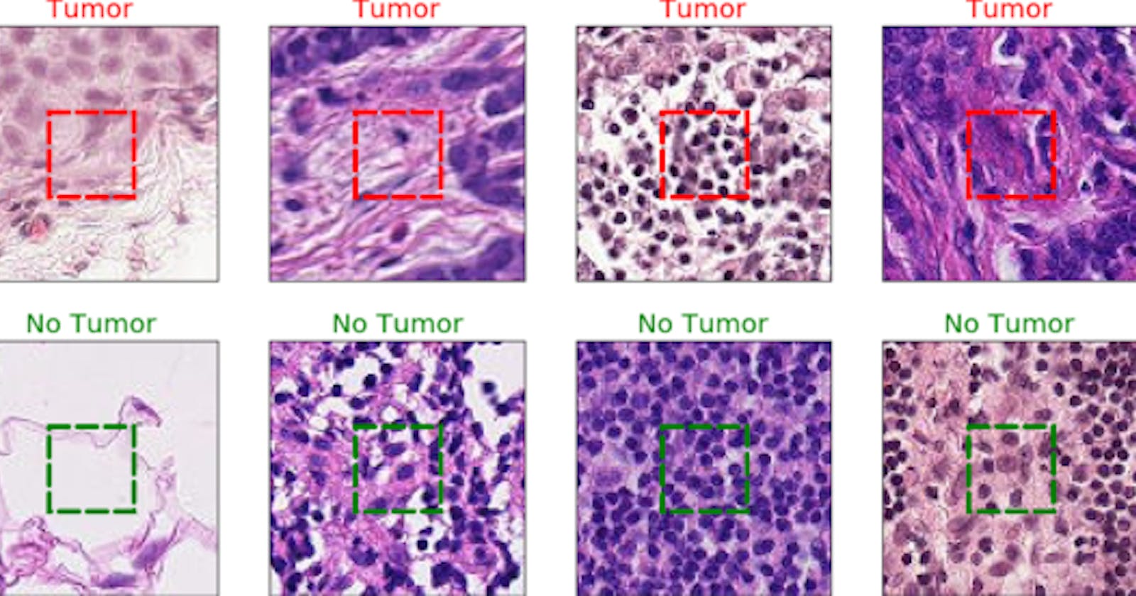 Convolutional Neural Network for Detecting Cancer Tumors in Microscopic Images