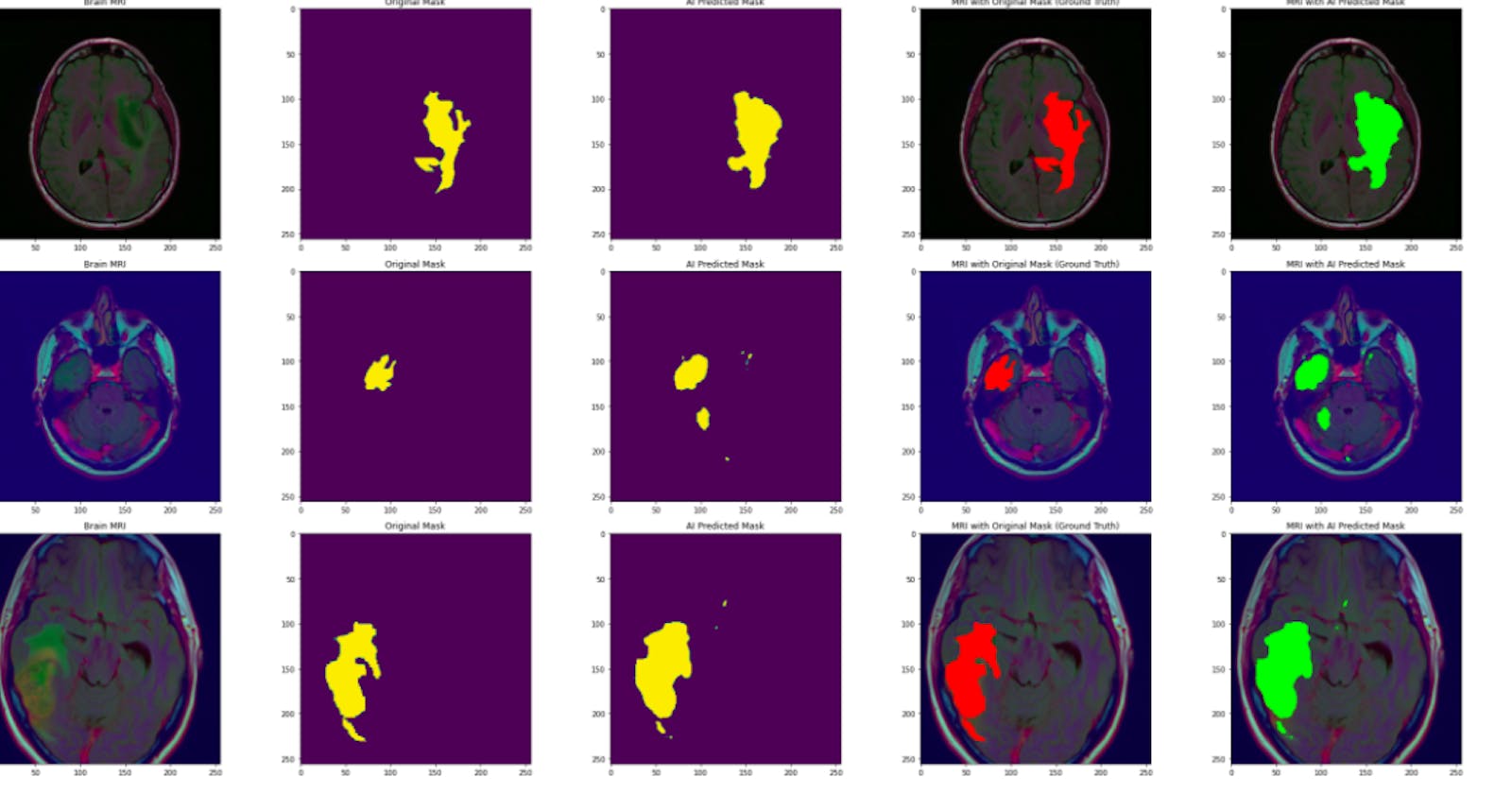 Brain Tumor Detection and Segmentation Model