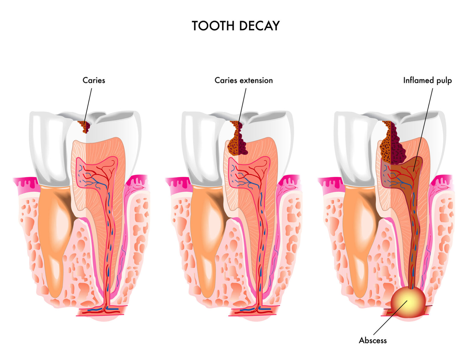 Dental-Caries-1568x1176.jpg