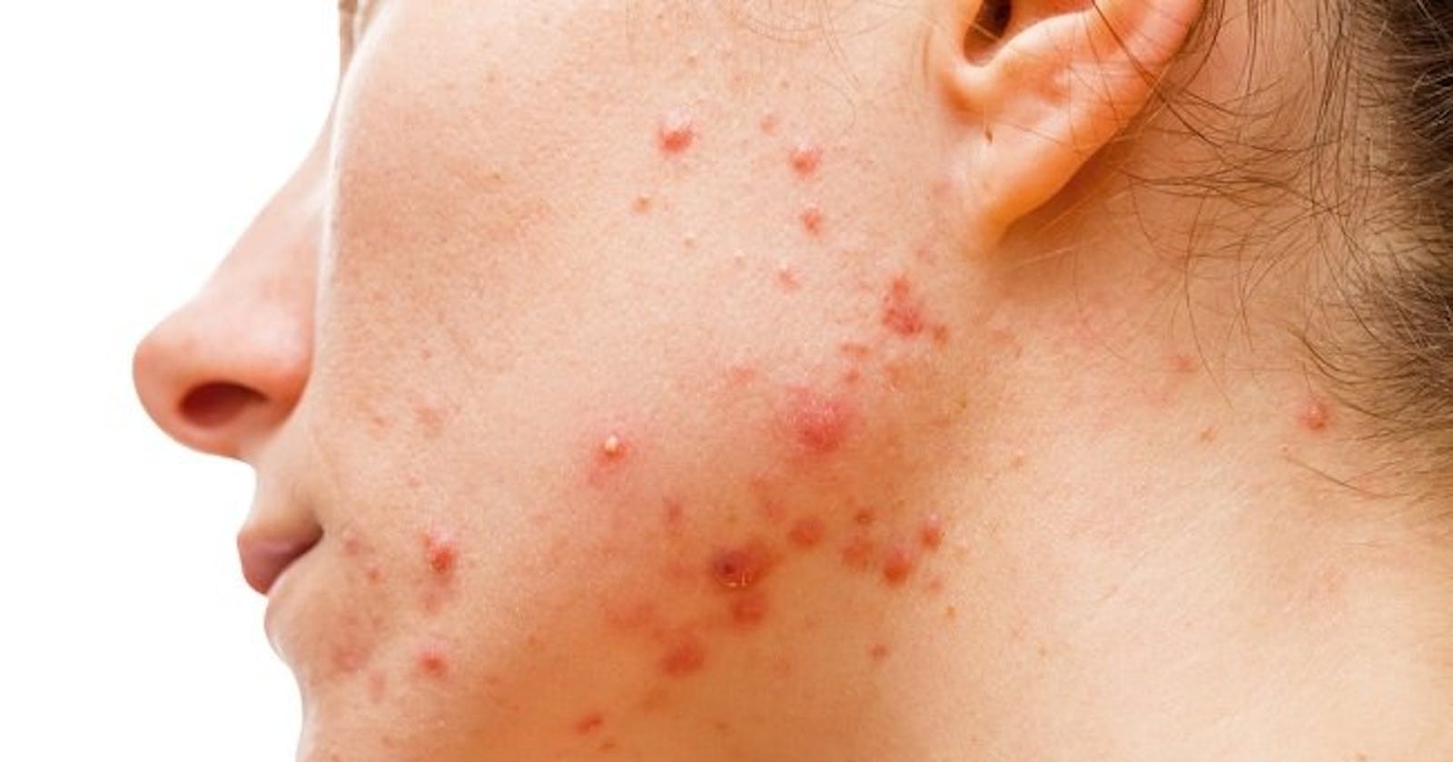 How to Overcome Severe Acne on the Face