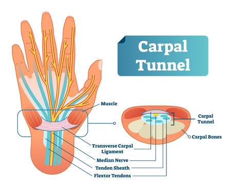 114805136-carpal-tunnel-vector-illustration-scheme-medical-labeled-diagram-closeup-with-isolated-muscle-transv.jpg
