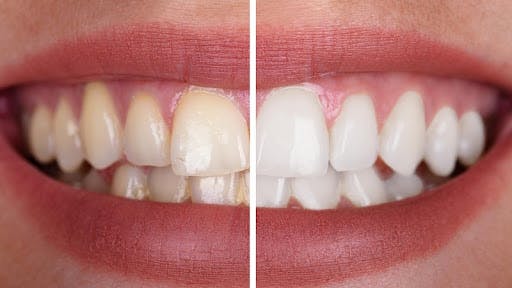 Sử dụng bột tẩy trắng giúp ngăn ngừa vết ố vàng trên răng