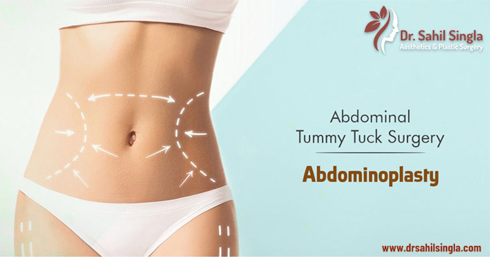 Abdominoplasty: Who is it for?