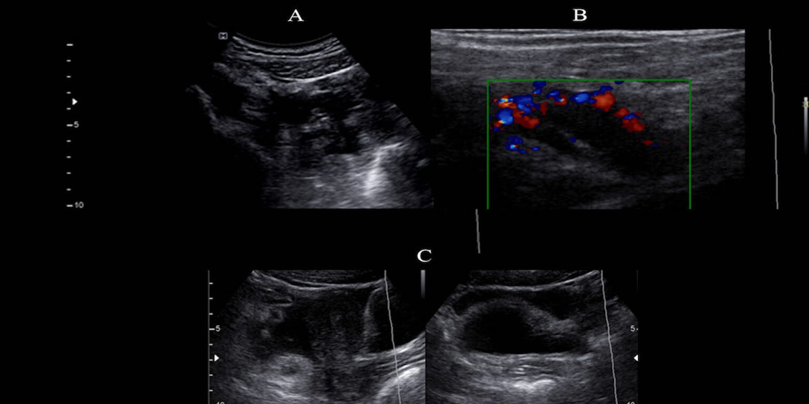 Ultrasonographic Findings In Patients Diagnosed With Acute Appendicitis