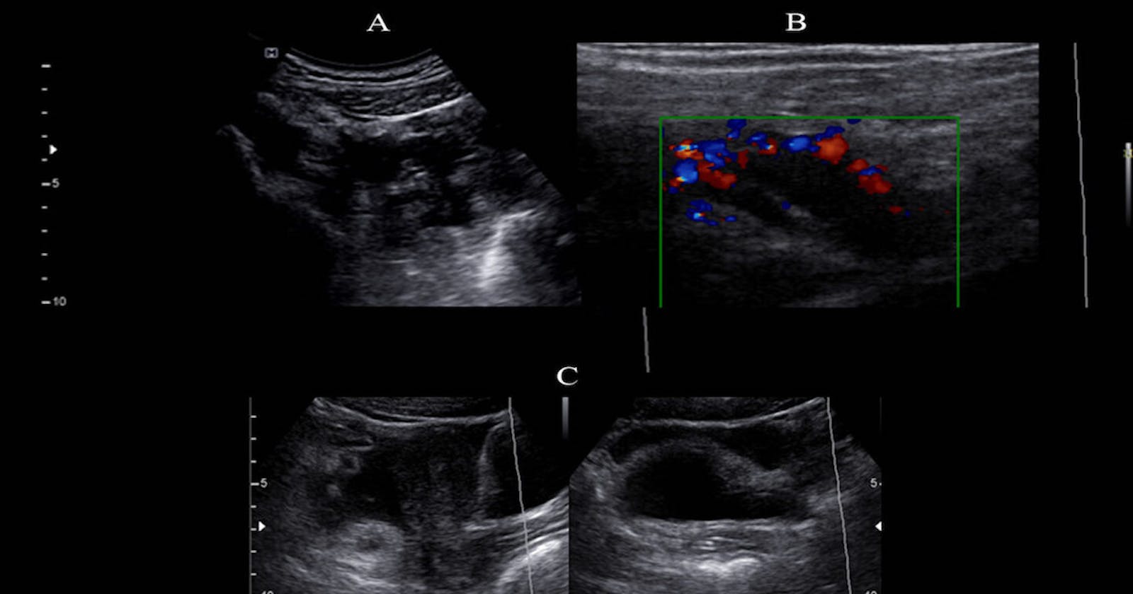 Ultrasonographic Findings In Patients Diagnosed With Acute Appendicitis