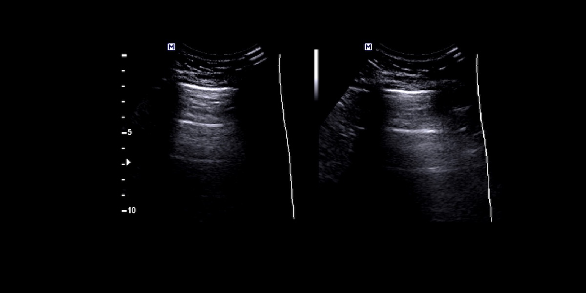 Findings In Lung Ultrasound That Predict A Poor Prognosis In Patients With Covid-19