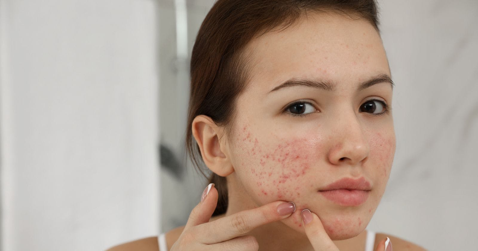 How to Deal with Pimples and Acne Scars?