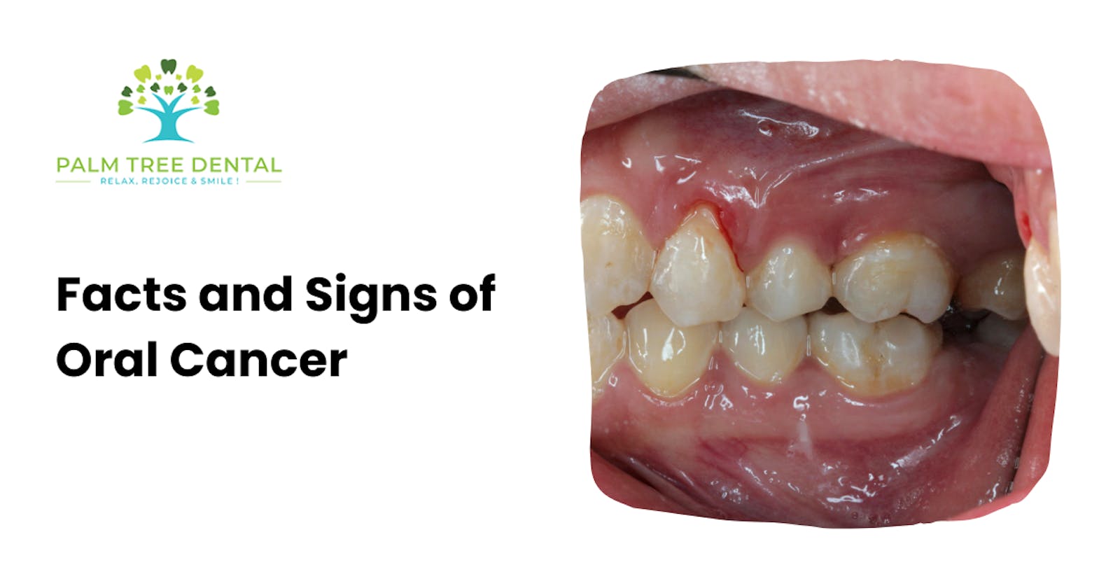 Facts and Signs of Oral Cancer