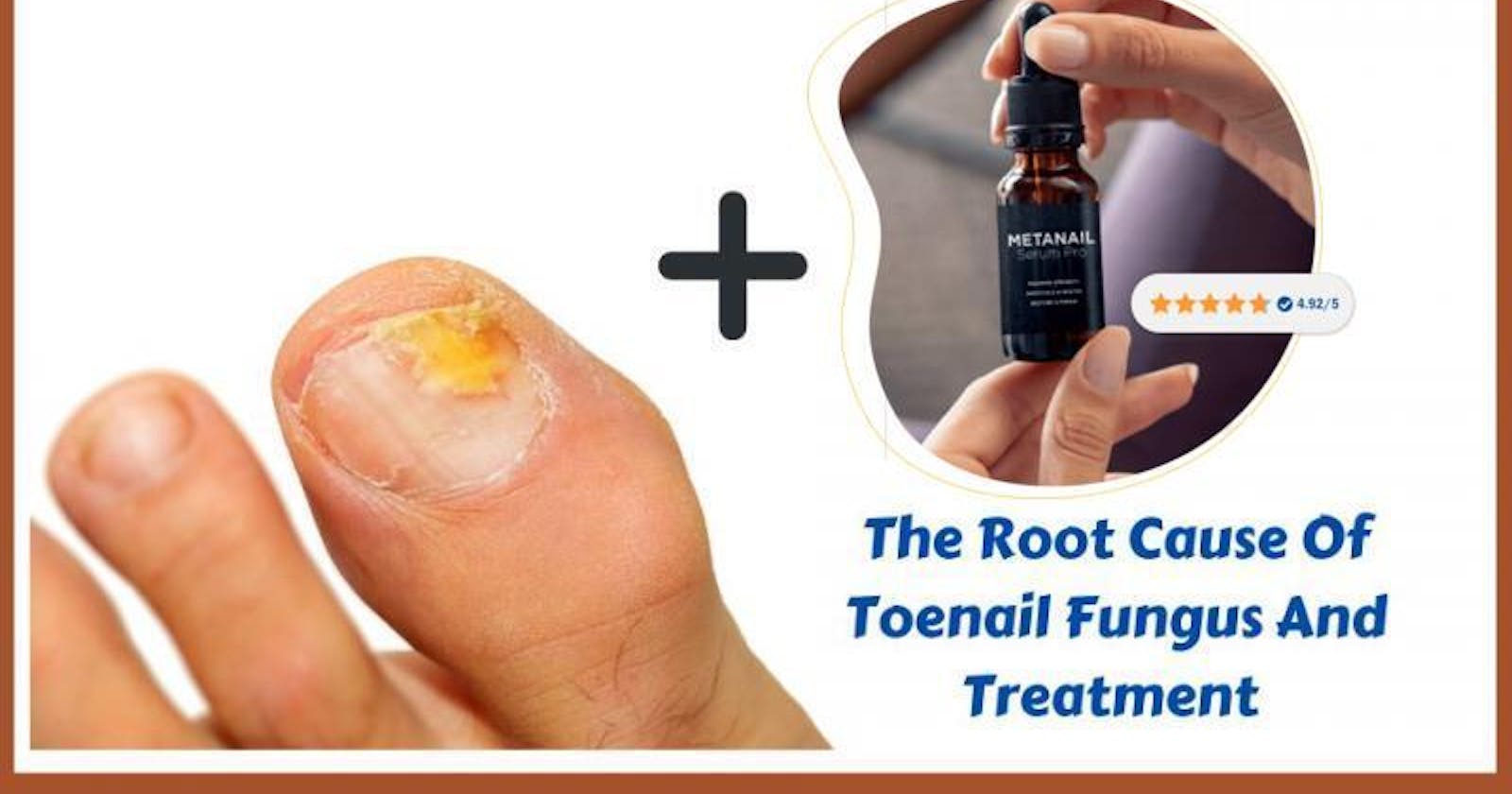 Metanail Serum Pro [Feet Nail Fungus Essention Formula] Includes Powerful Ingredients!