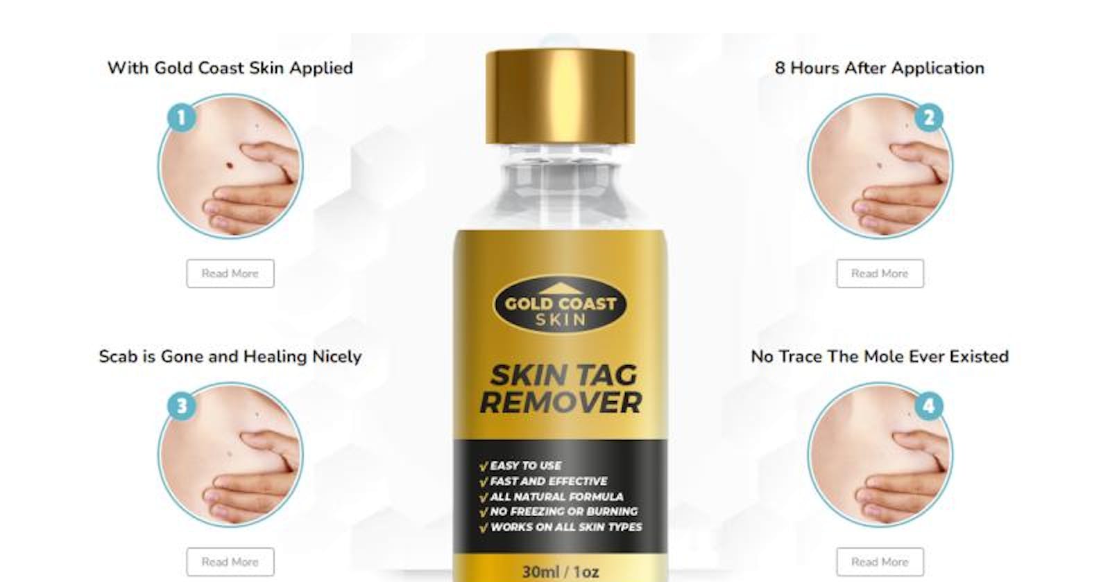 Gold Coast Skin Tag Remover Amazon : Ingredients  Advantage, Price & Where can I buy?