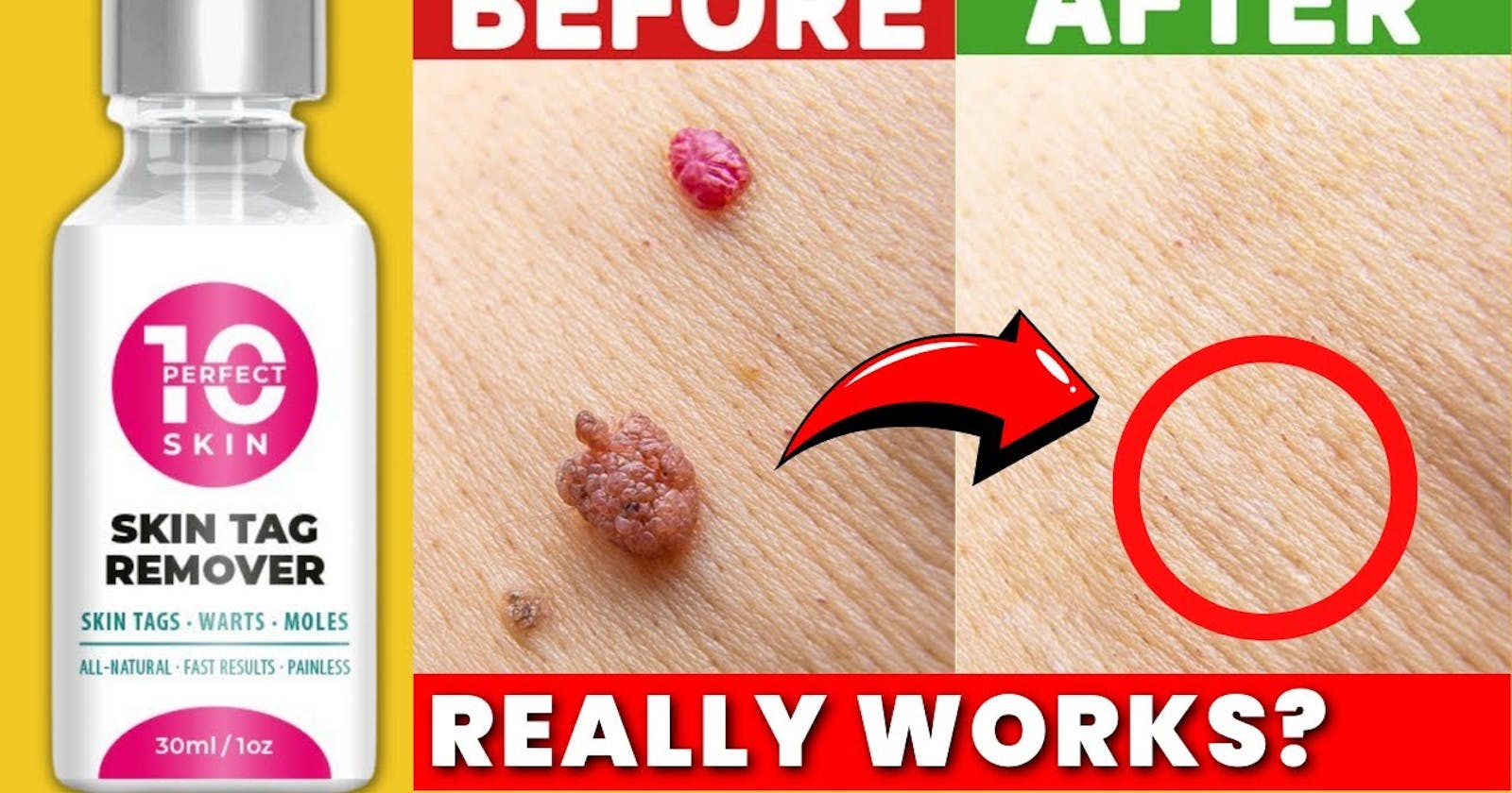 Perfect 10 Skin Tag Remover REVIEWS [Scam OR Legit] Exposed Benefits Price