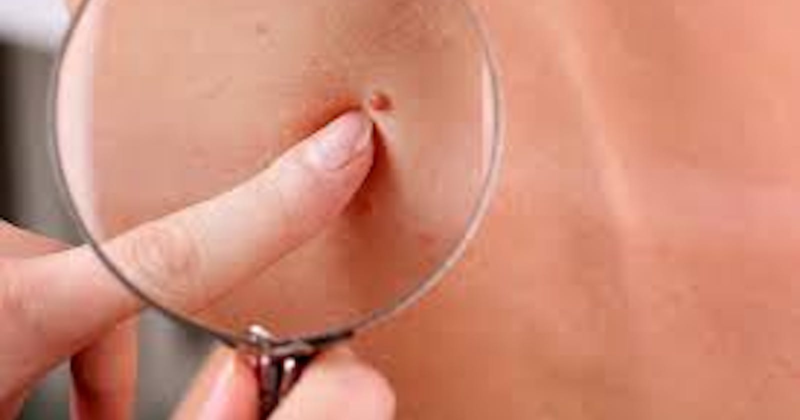 Lavelle Skin Tag Remover Benefits