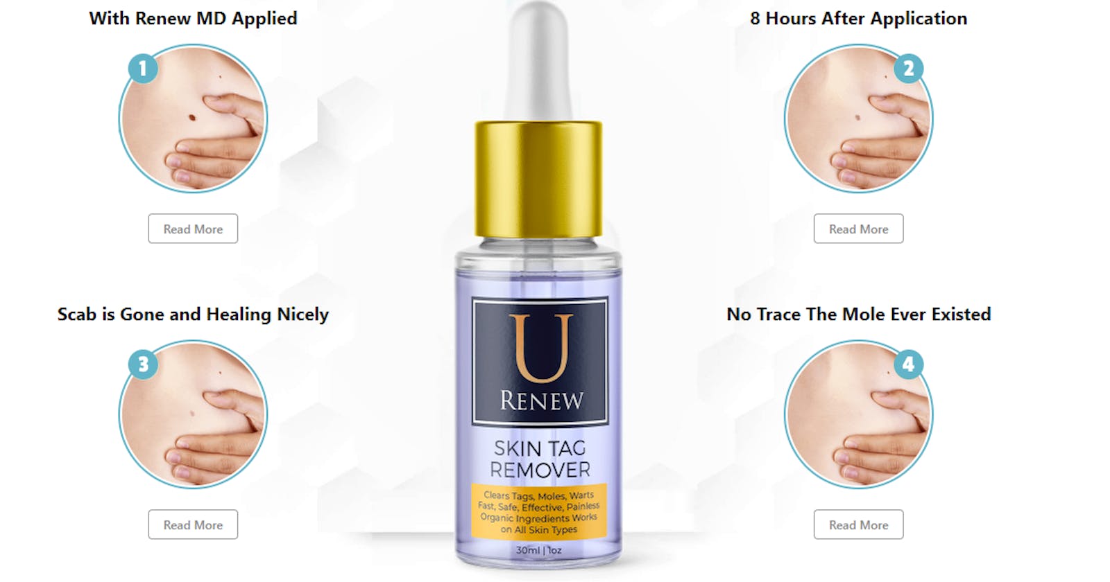 Remove Skin Tags Safely and Easily with U Renew Skin Tag Remover