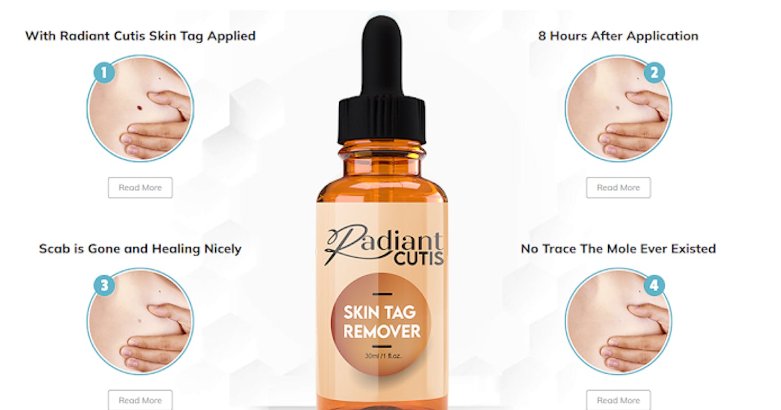 Radiant Cutis Skin Tag Remover | Utopia Skin Tag Remover Reviews 2023