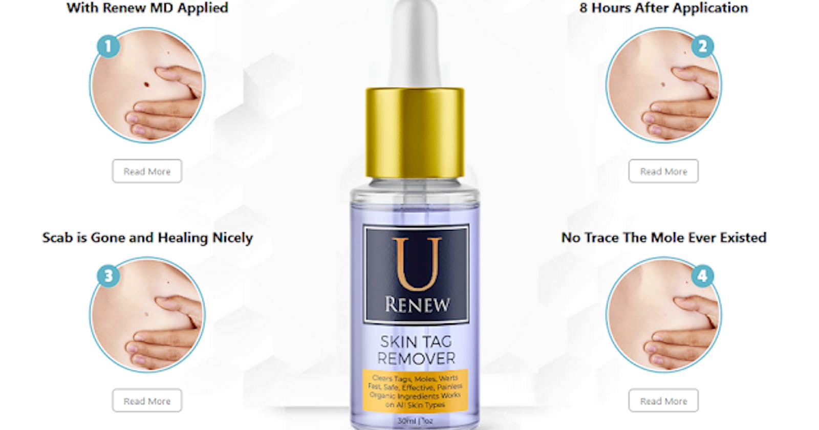 U Renew Skin Tag Remover - An Anti-Aging Formula For Wrinkle