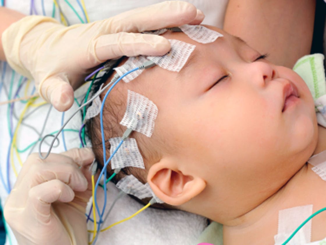 Cracking the Code of Epilepsy: Unleashing the Power of EEG