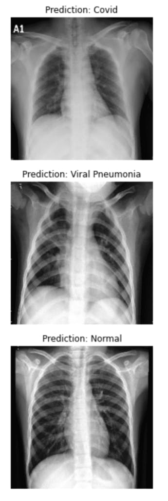 Xray heart . In this X-Ray deep learnng model predict