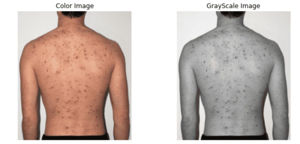 Two images one color another grayscale describe  skin cancer 