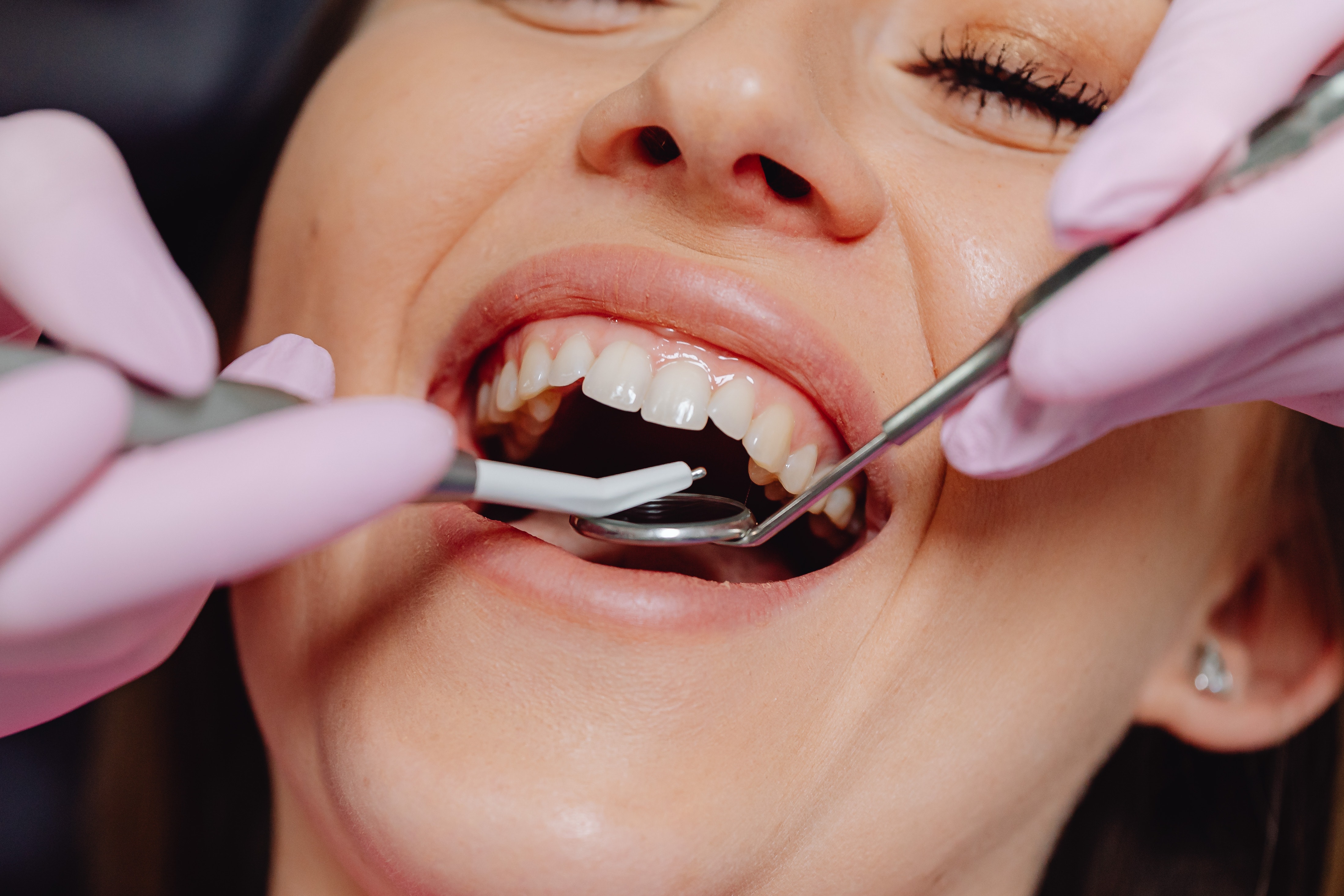 What You Need to Know About Dental Implants Melbourne