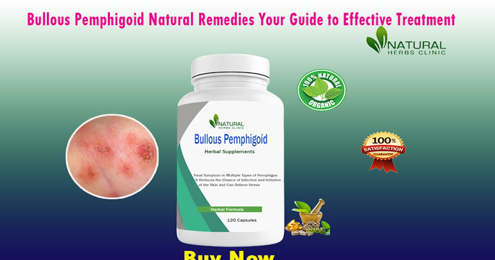 Transform Your Life with Natural Home Treatment for Bullous Pemphigoid