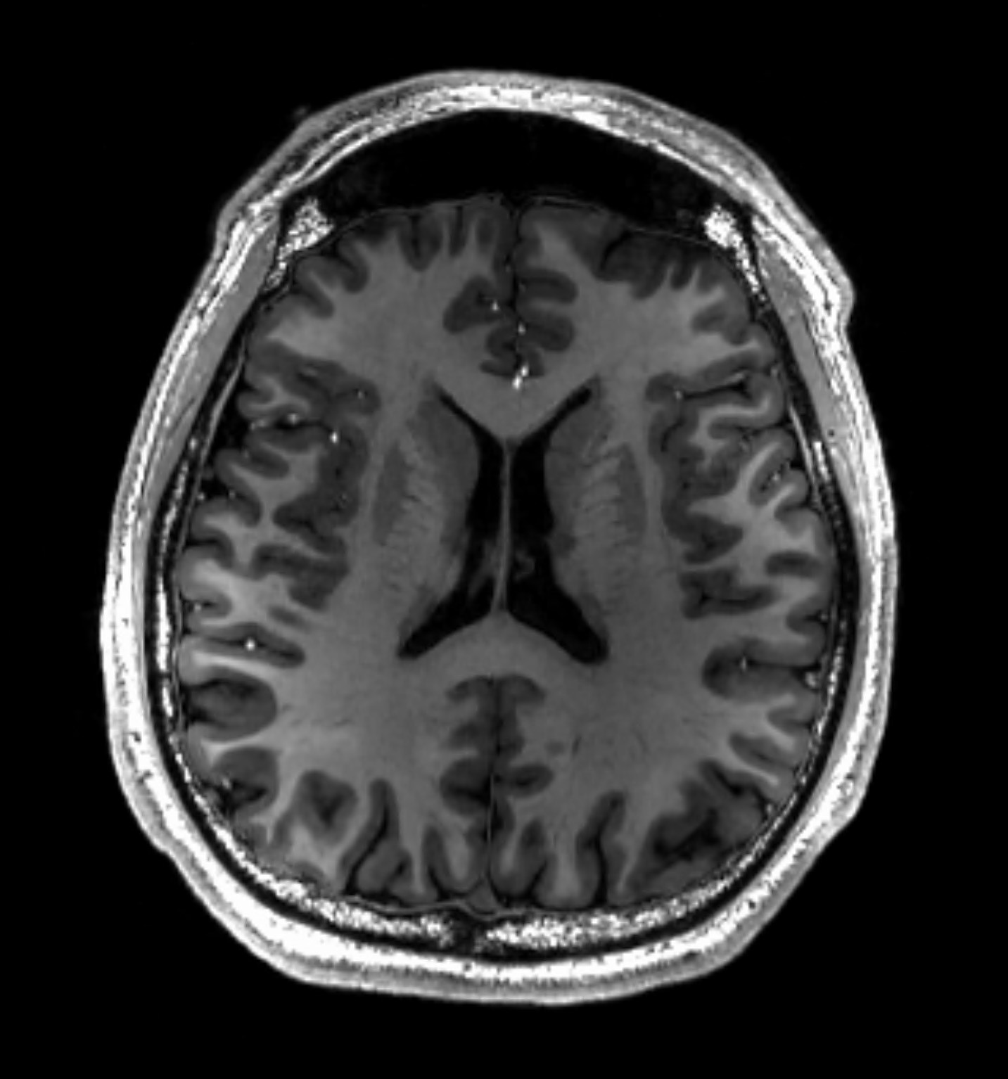 Brain Tumor Detection 🧠