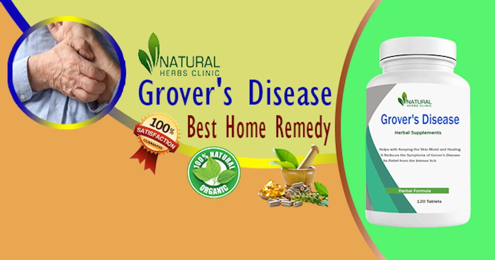 Effective Home Treatments for Grover’s Disease: Ultimate Guide