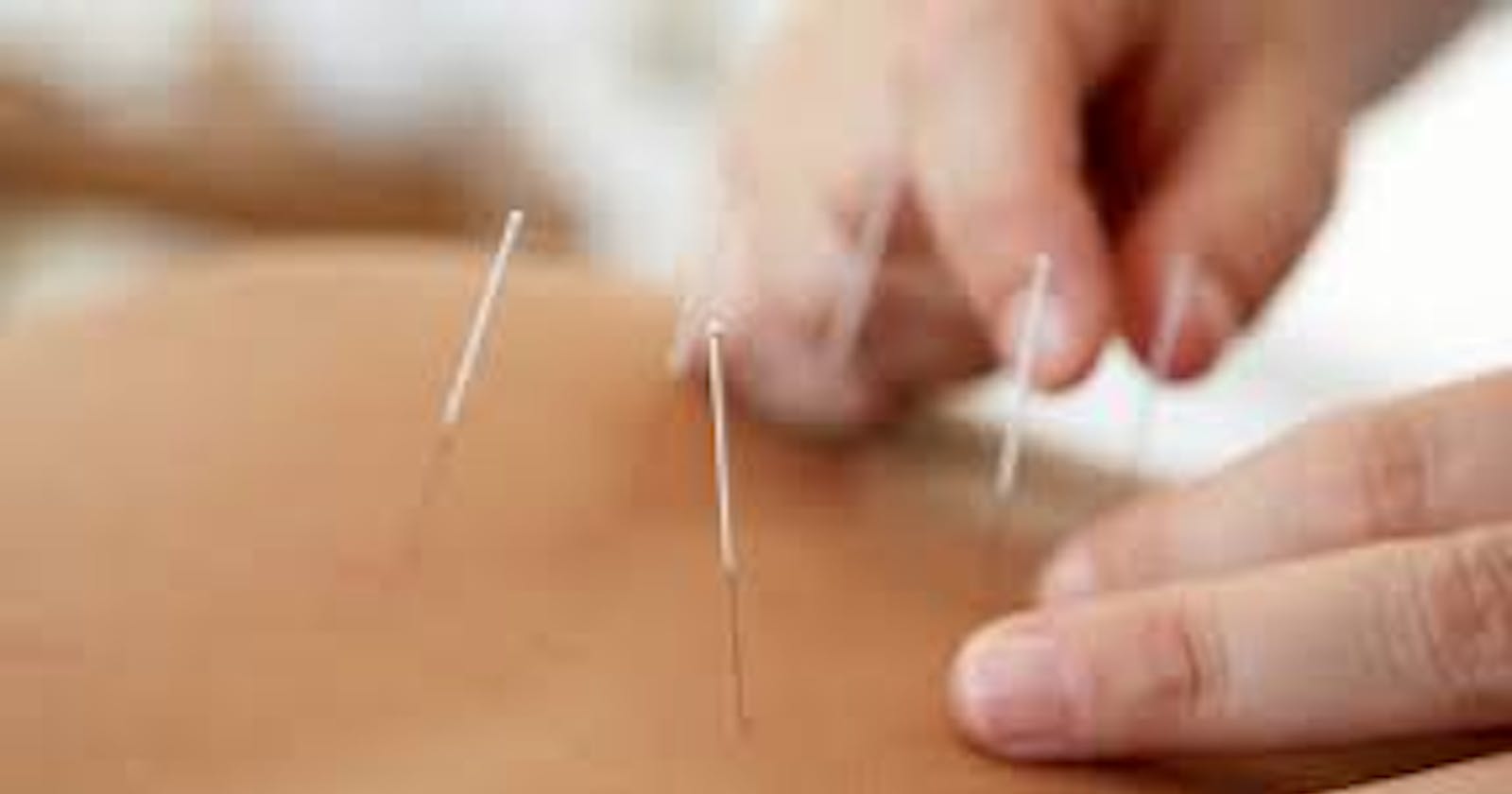 Everything You Must Know About Acupuncture for Stroke in Morristown