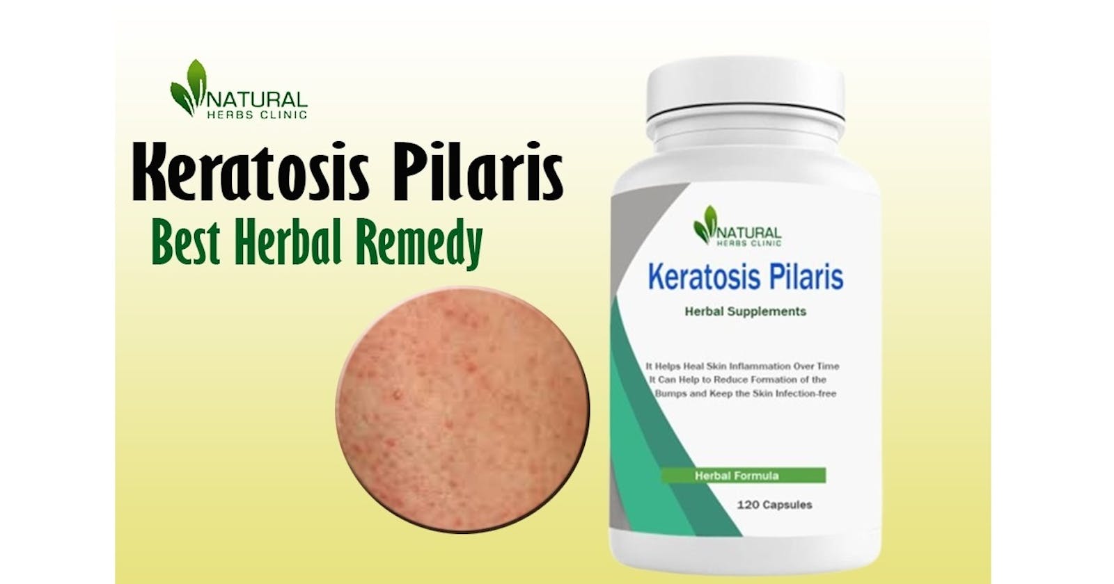 Supplements For Keratosis Pilaris: Unlocking Natural Remedies Secrets