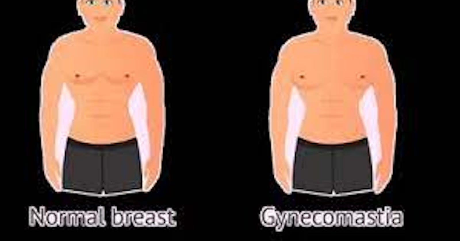 Gynectrol Review: The Ultimate Solution for Gynecomastia?