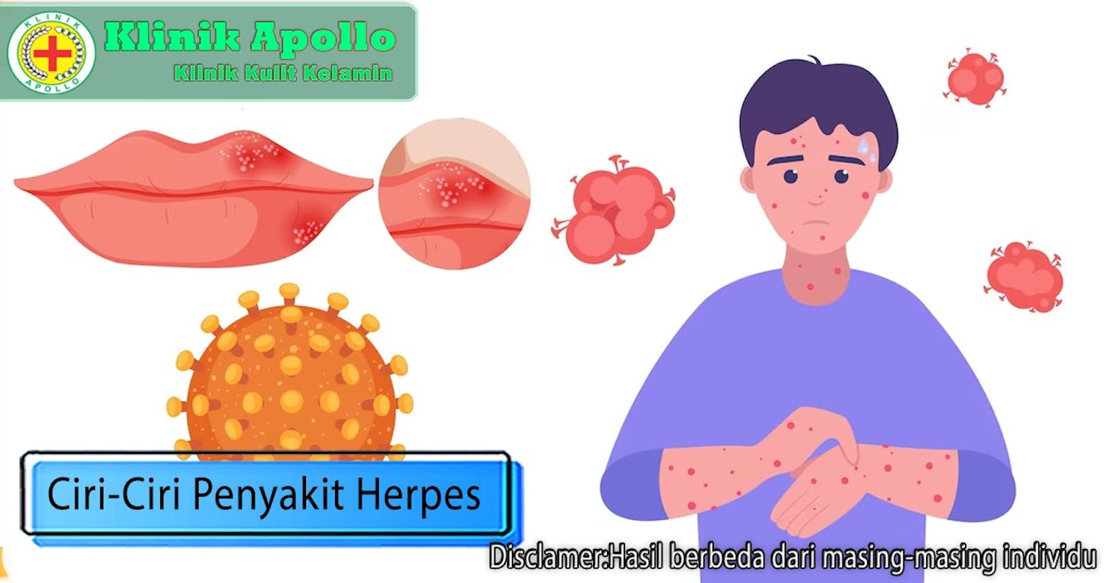 Bahaya! Inilah 4 Ciri-Ciri Penyakit Herpes
