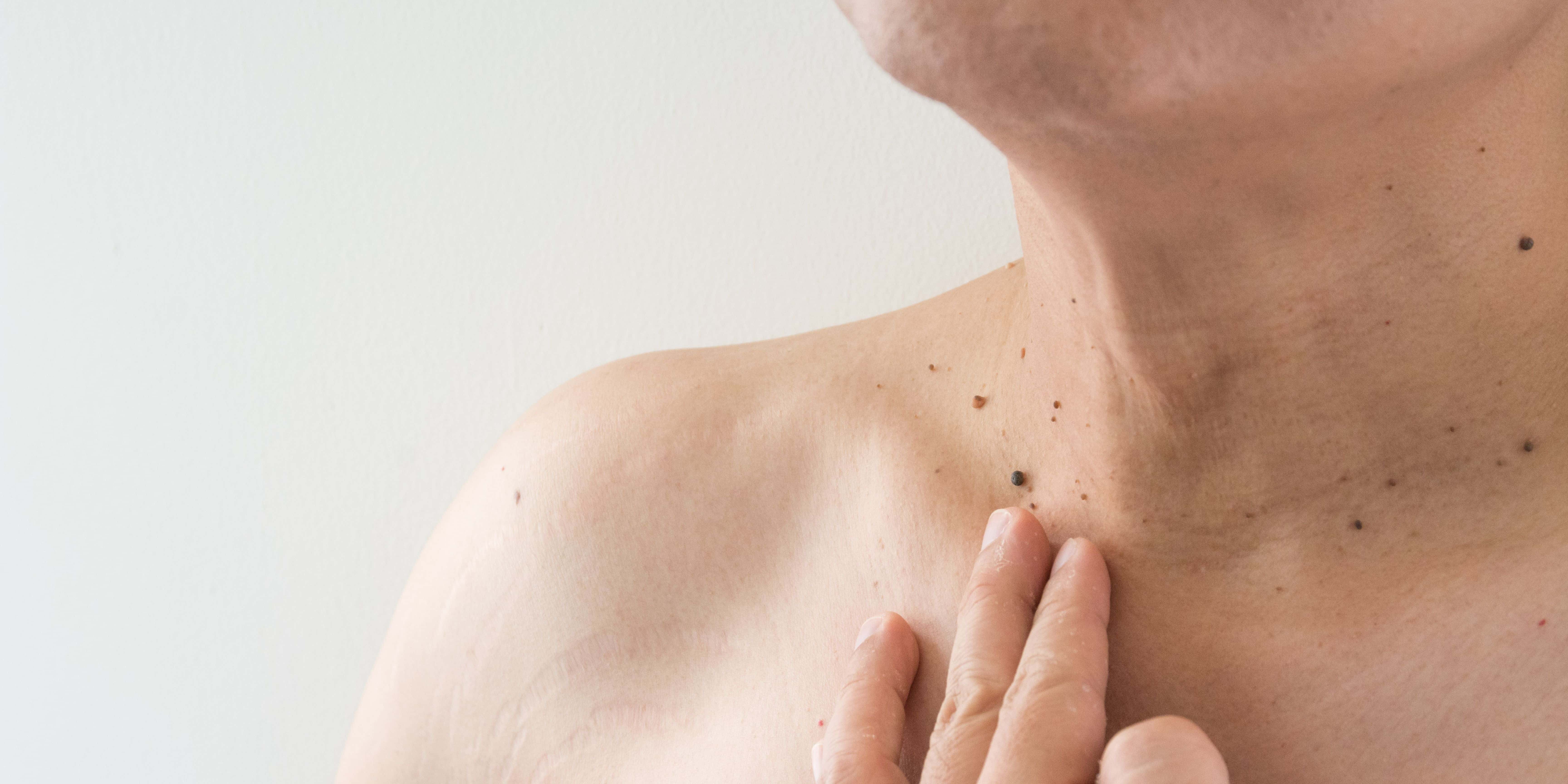 Unlock Your Skin's Potential: Clean As Teen Skin Tag Remover Revolution