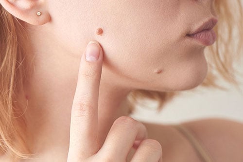 Revitalize Your Confidence: Clean As Teen Skin Tag Remover's Power!