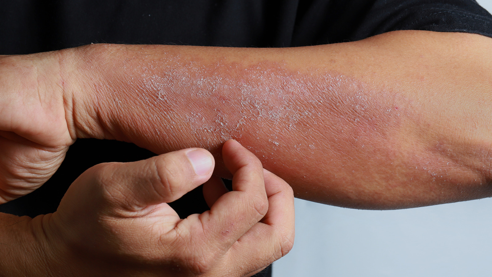 Guide to Psoriasis Treatment by Lahore's Premier Skin Specialists at Institute Cosmetique