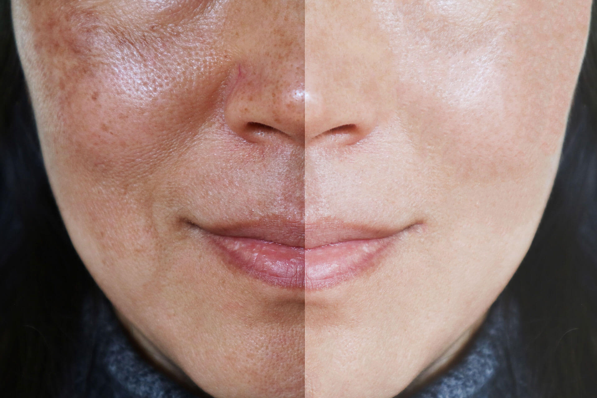 Guide to Melasma Treatment by Skin Specialists in Lahore at Cosmetique