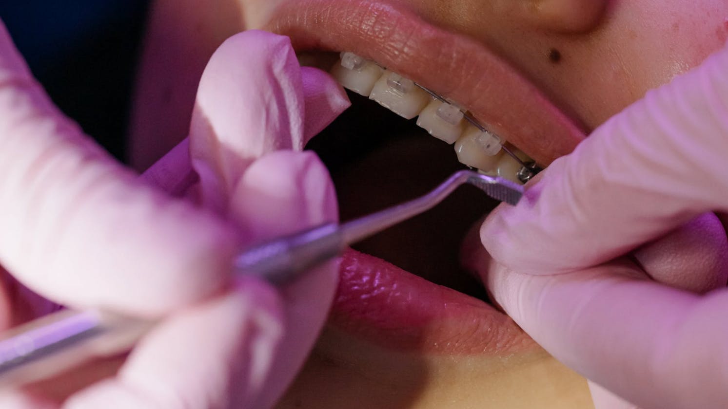 Unlock Your Confident Smile Journey with Expert Braces Treatment at Masri Orthodontics!