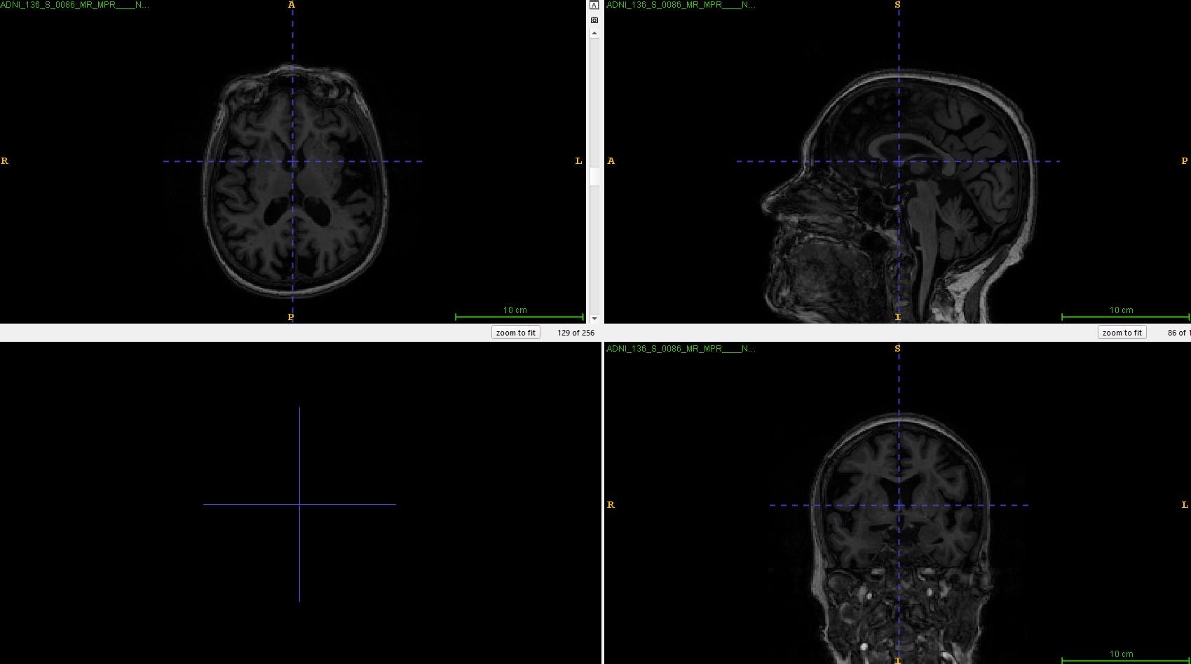 RAW Brain MRI Image in 3D from ADNI