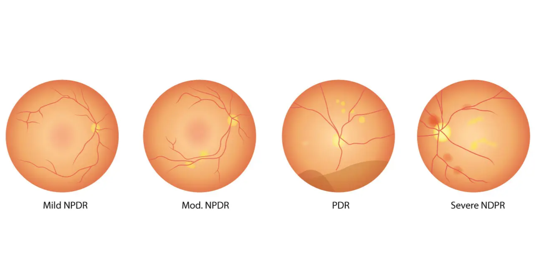 Decoding Diabetic Retinopathy: A Deep Dive into Multi-Class Classification with SVM and ANN