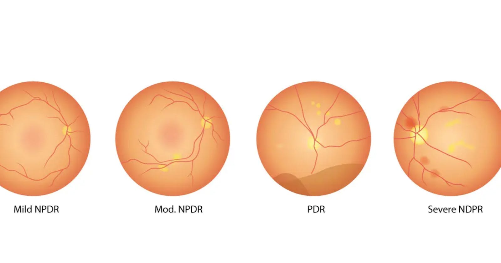 Decoding Diabetic Retinopathy: A Deep Dive into Multi-Class Classification with SVM and ANN
