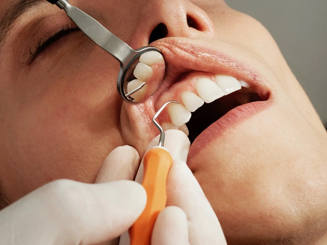 Transforming Smiles: The Invisalign Experience in Mt Hawthorn