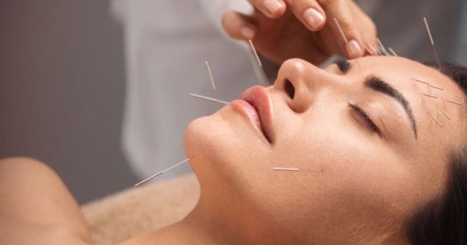 Harnessing Ancient Wisdom: Acupuncture for Rejuvenated Facial Skin