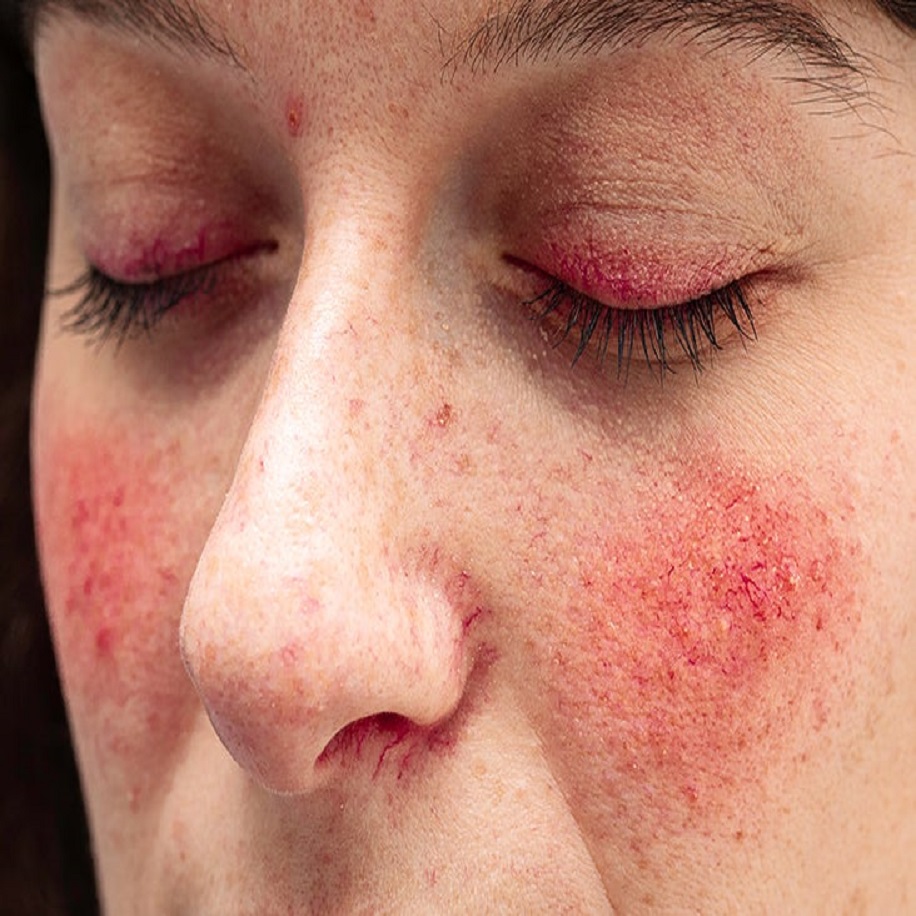 "Rosacea Reimagined: Embracing a Clearer Future with Targeted Therapies"