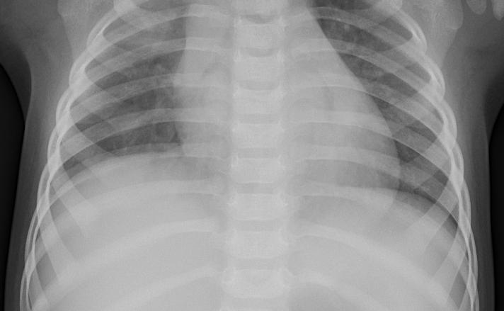 Pneumonia Detection using Quantum Transfer Learning