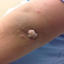 "Warts Begone: The Latest Innovations in Treatment"