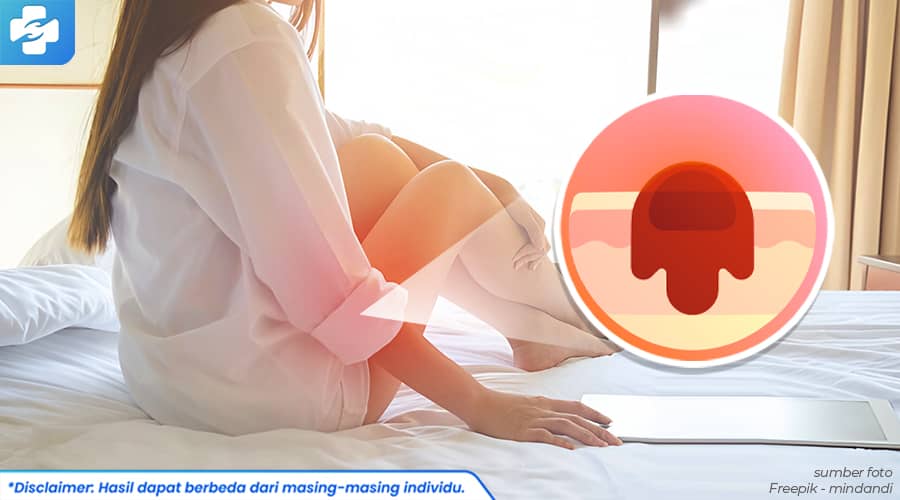 5 Pantangan Agar Benjolan di Kelamin Wanita Cepat Sembuh Nih!
