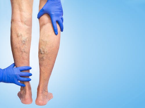 varicose veins