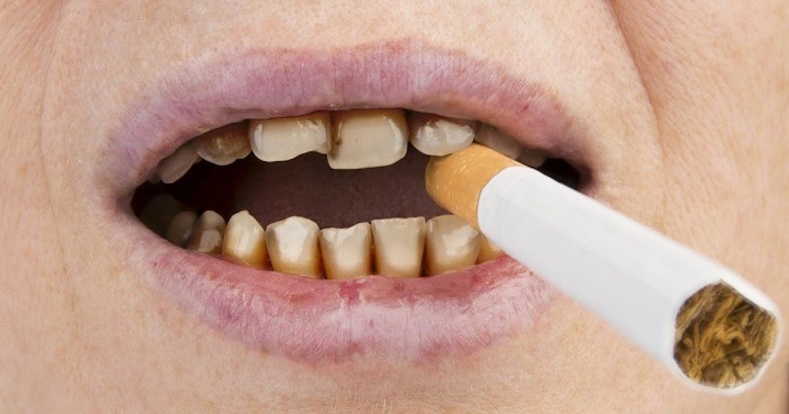 Unveiling the Secrets of Teeth Whitening for Smokers in Dubai