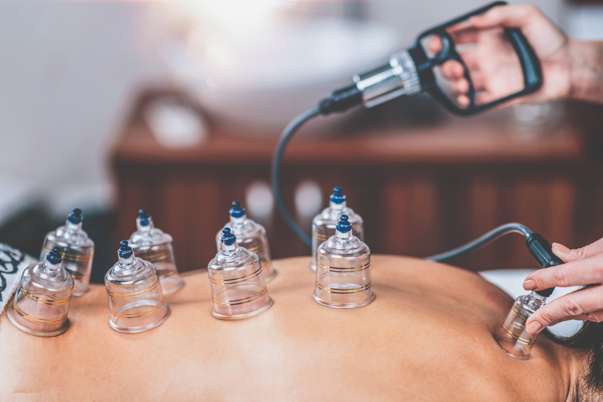 Beyond Expectations: Achieving Ultimate Satisfaction with Hijama Cupping Therapy in Dubai