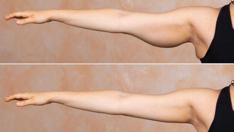Price Tag Precision: The True Cost of Arm Lifts in Dubai
