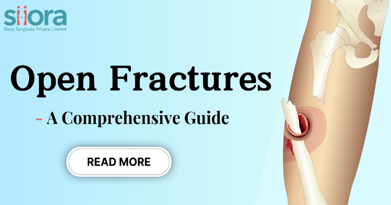 Open Fractures - A Comprehensive Guide
